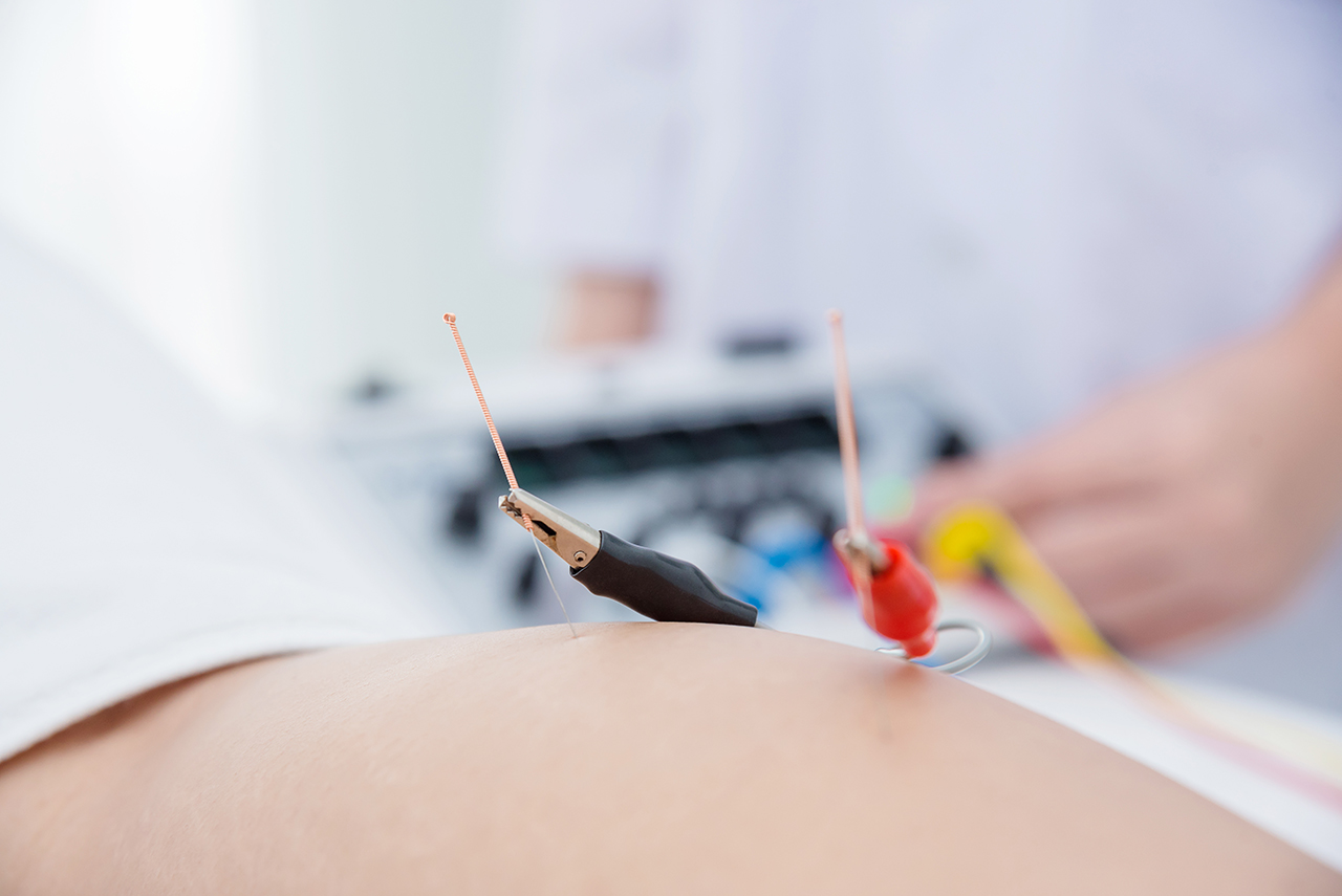 Electro Acupuncture Near Me